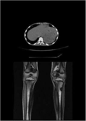 Neuroblastic tumors and neurofibromatosis type 1: A retrospective multicenter study in Italy and systematic review of the literature